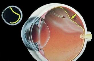 ¿Cuáles son los síntomas y el tratamiento del desprendimiento de retina?