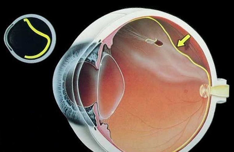 Desprendimiento de retina. Foto: oftalmoruiz.com