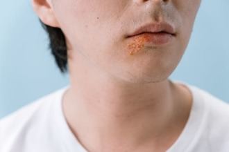 El herpes labial podría multiplicar el riesgo de Alzheimer