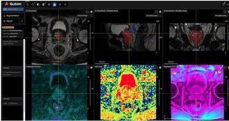 La IA de Philips en Resonancia Magnética (RM) y el software de análisis de Quibim mejoran las estudios de cáncer de próstata