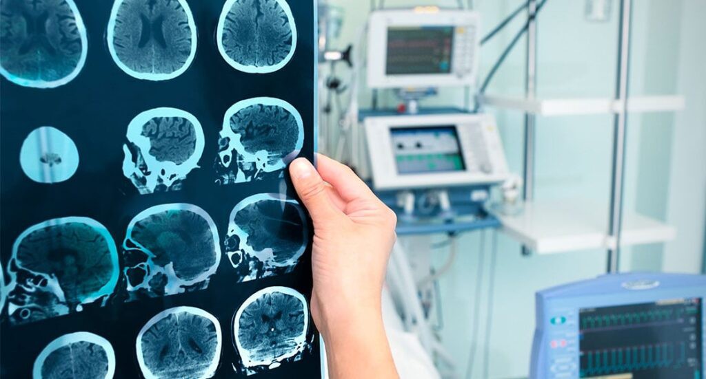 Alteraciones cerebrales en pacientes con Alzheimer y su impacto en la vida diaria