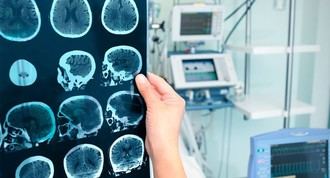 Alteraciones cerebrales en pacientes con Alzheimer y su impacto en la vida diaria