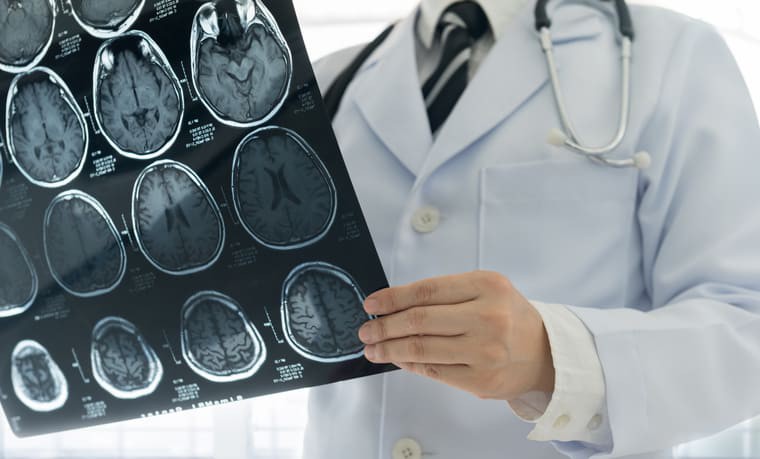 Microinfartos cerebrales: cómo identificarlos y prevenir su impacto en la salud cognitiva
